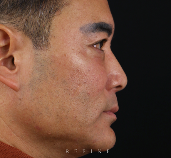 Nose filler before photo — patient showing dorsal hump and nasal asymmetry prior to non-surgical rhinoplasty — Dr. Paul Denton, Refine Cosmetic Surgery Vancouver BC
