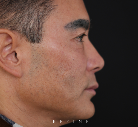 Nose filler after photo — smoothed dorsal profile and improved nasal symmetry following liquid rhinoplasty with dermal filler — Dr. Paul Denton, Refine Cosmetic Surgery Vancouver BC