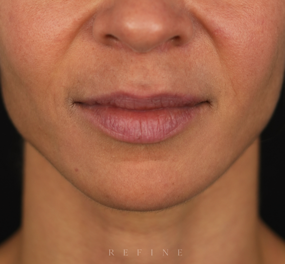 Lip lift surgery before photo — patient showing upper lip position prior to procedure — Dr. Paul Denton, Refine Cosmetic Surgery Vancouver BC