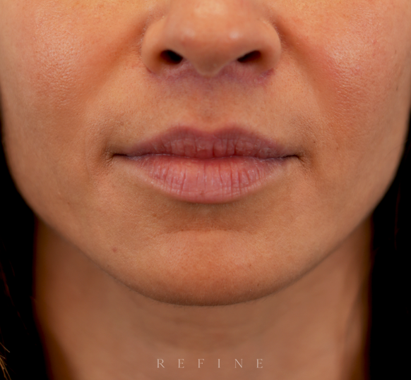 Lip lift surgery after photo — elevated upper lip and improved vermillion show following lip lift — Dr. Paul Denton, Refine Cosmetic Surgery Vancouver BC