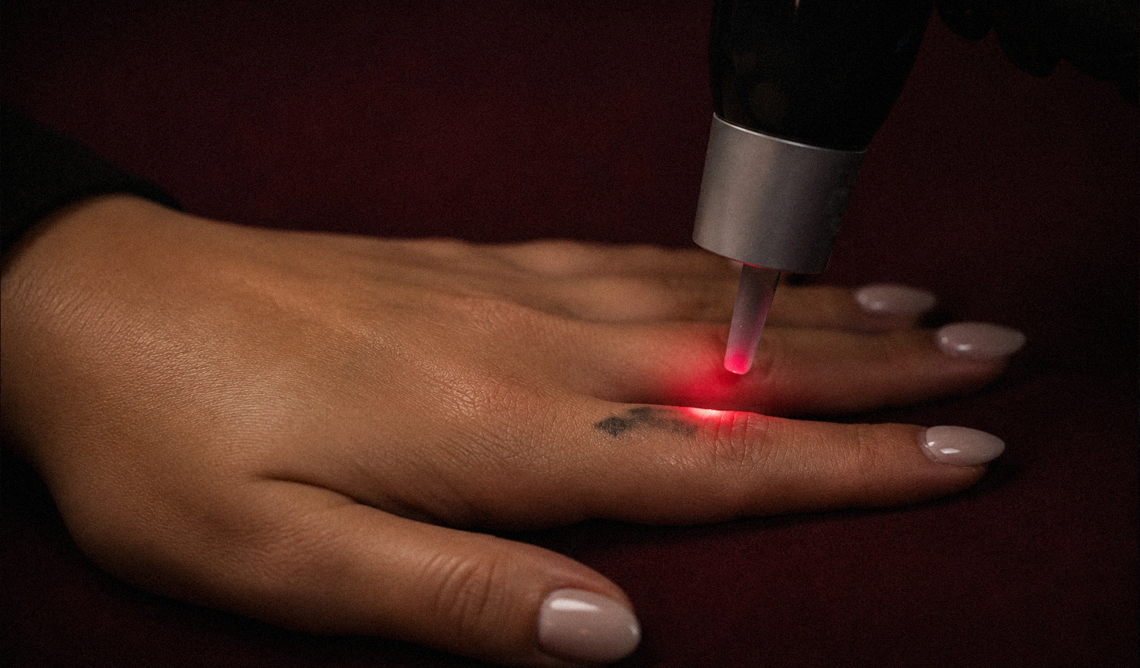 A patient that is having tattoo removal procedure at Refine Cosmetic Surgery in Vancouver, BC
