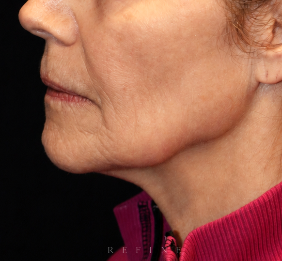 Before photo of a patient in her 60's pre-operation of a deep plane face and neck lift, a lip lift and fat grafting by Dr. Paul Denton located in Vancouver, BC at Refine Cosmetic Surgery