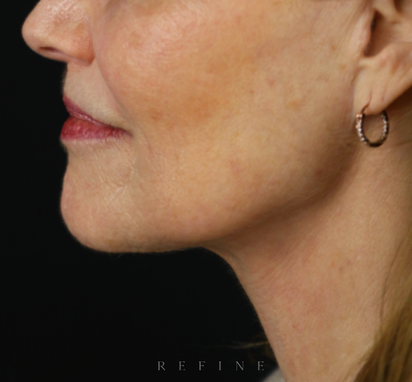 After photo of a patient in her 60's post operation of a deep plane face and neck lift, a lip lift and fat grafting by Dr. Paul Denton located in Vancouver, BC at Refine Cosmetic Surgery