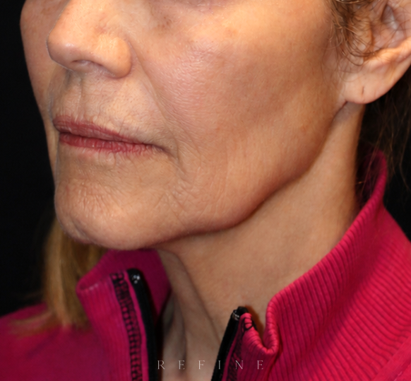 Before photo of a patient in her 60's pre operation of a deep plane face and neck lift, a lip lift and fat grafting by Dr. Paul Denton located in Vancouver, BC at Refine Cosmetic Surgery.