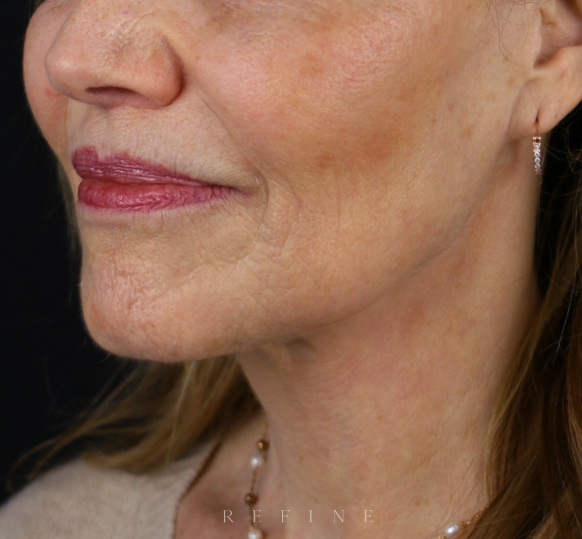 After photo of a patient in her 60's post operation of a deep plane face and neck lift, a lip lift and fat grafting by Dr. Paul Denton located in Vancouver, BC at Refine Cosmetic Surgery