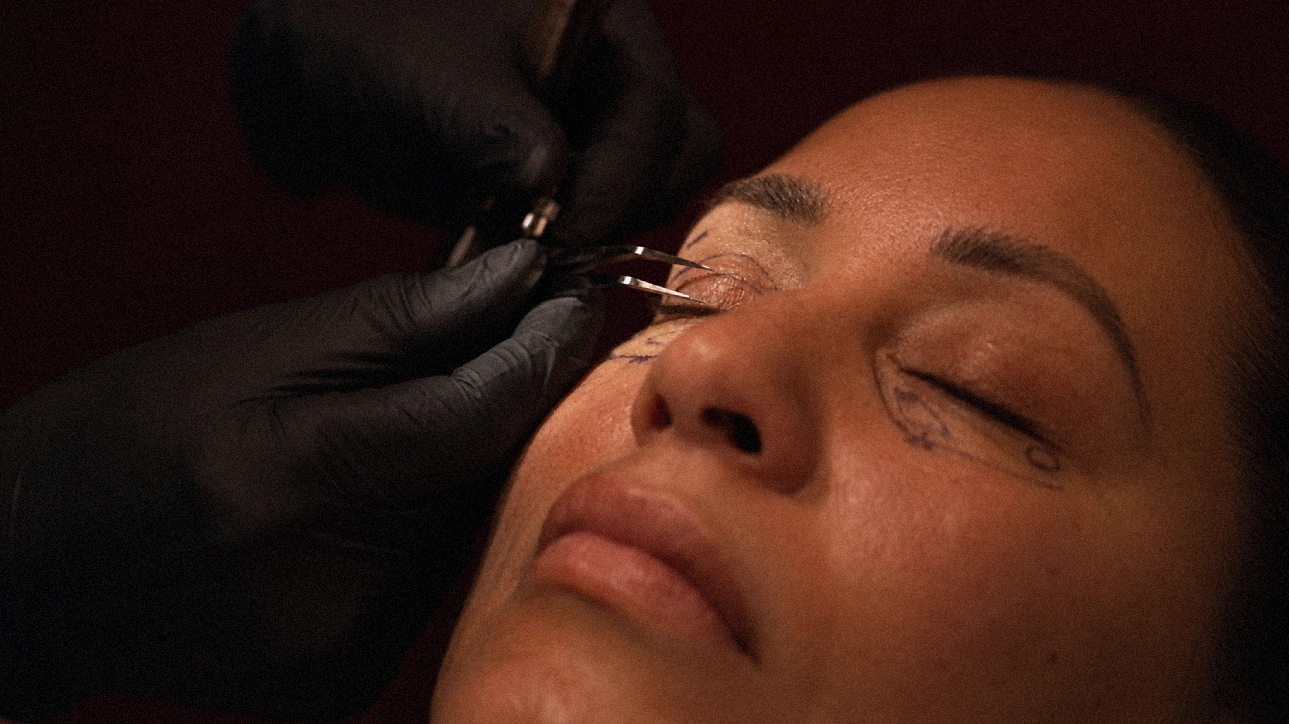 A patient undergoing upper and lower eyelid blepharoplasty surgery by Dr. Paul Denton at Refine Cosmetic Surgery located in Vancouver, BC