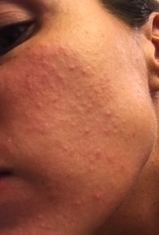 Diana's before picture with her face broken out