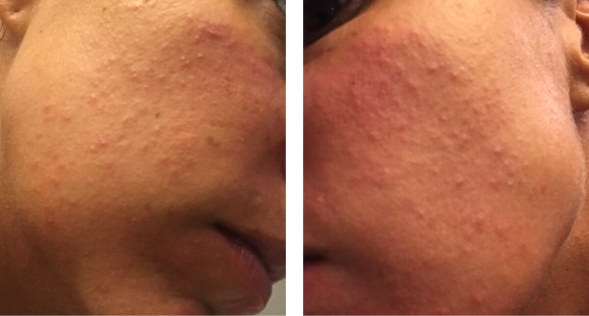 Diana's acne all over her cheeks