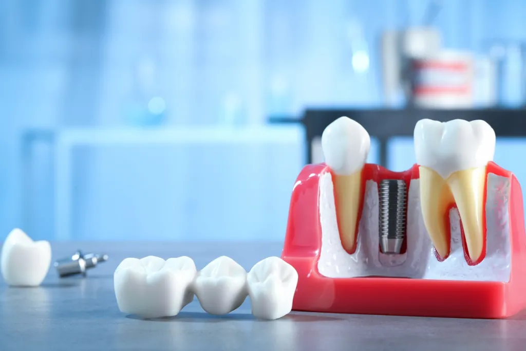 What You Should Know Before Choosing Dental Implants or Bridges
