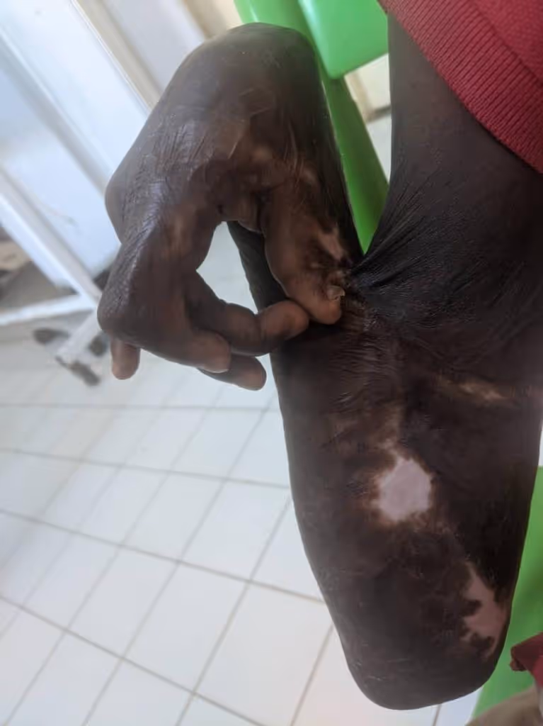 A person with vitiligo on their arm is seated, scratching their elbow.