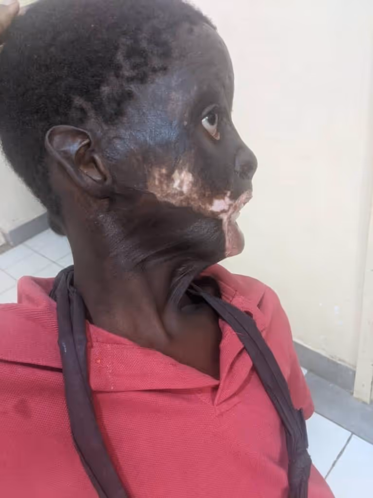 Person in a red shirt looks up, displaying visible facial scarring, sitting indoors.