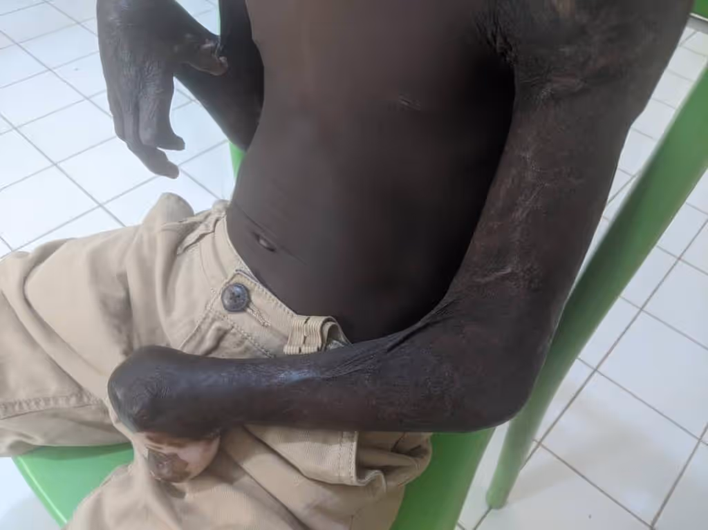 A person with visible skin condition sits on a green chair wearing beige pants.