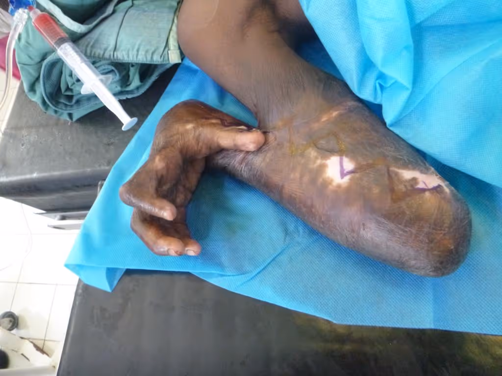 An arm wrapped in blue cloth, showing healing scars and stitches on the forearm.