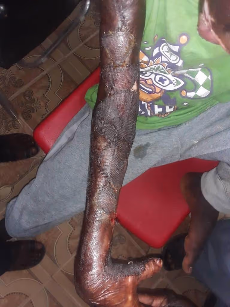 A person with a bandaged arm sits on a red chair, showing injury or treatment.