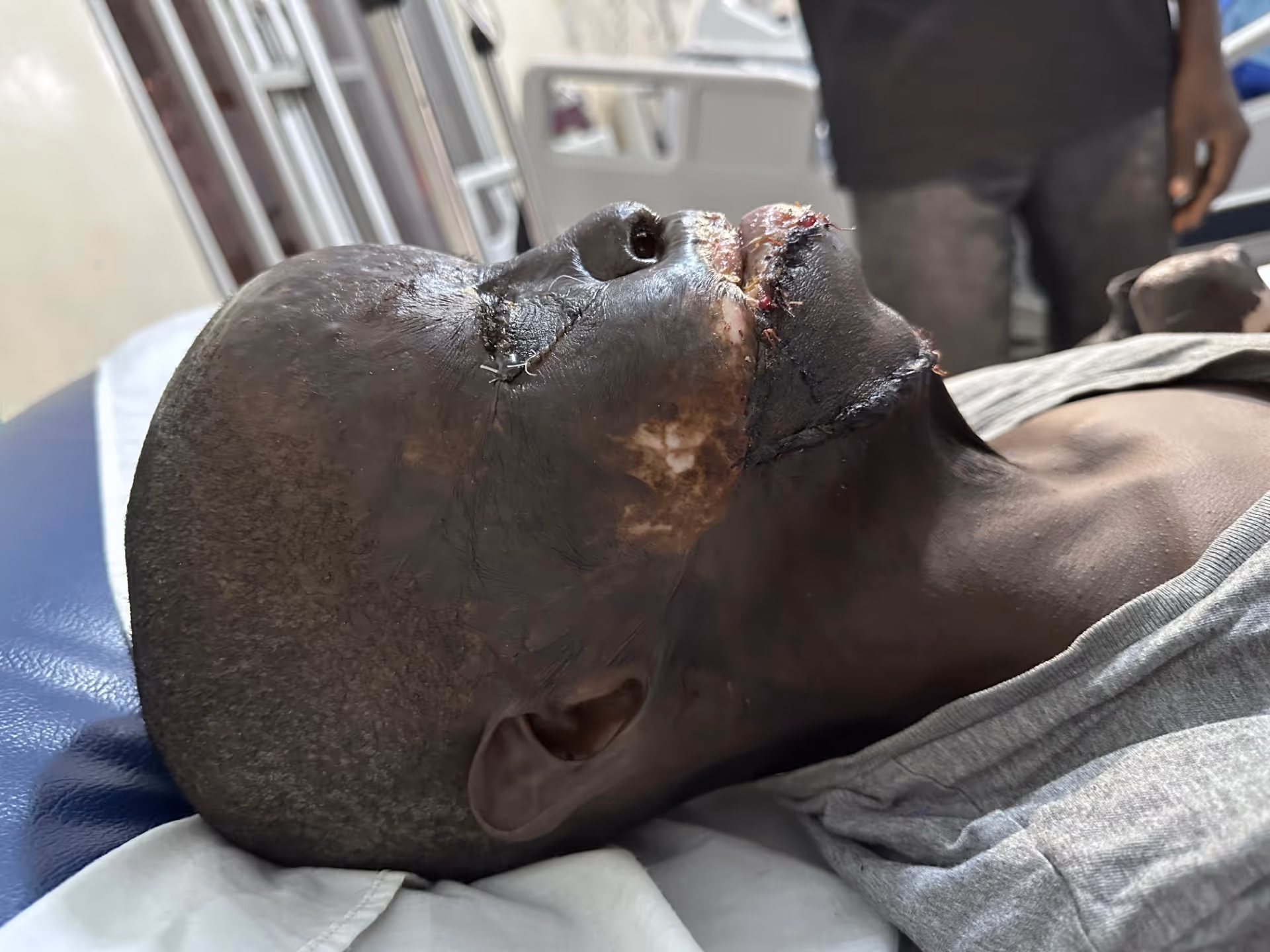 A person with severe facial injuries lies on a hospital bed, receiving medical attention.
