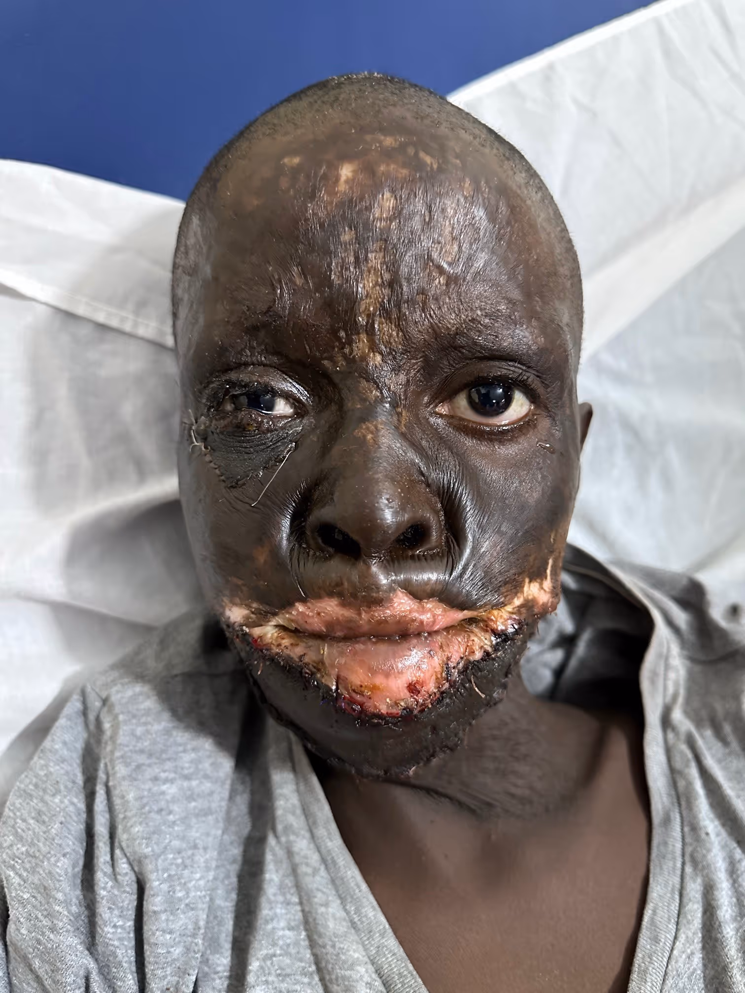 A person with severe facial burns wearing a gray shirt lies on a hospital bed.