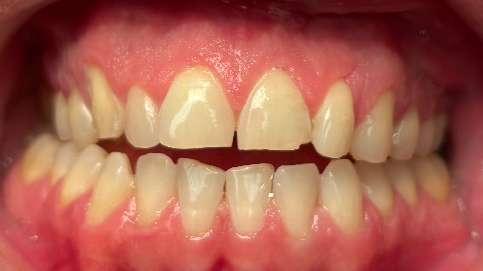 Close-up of upper and lower front teeth with slight gaps and healthy pink gums.