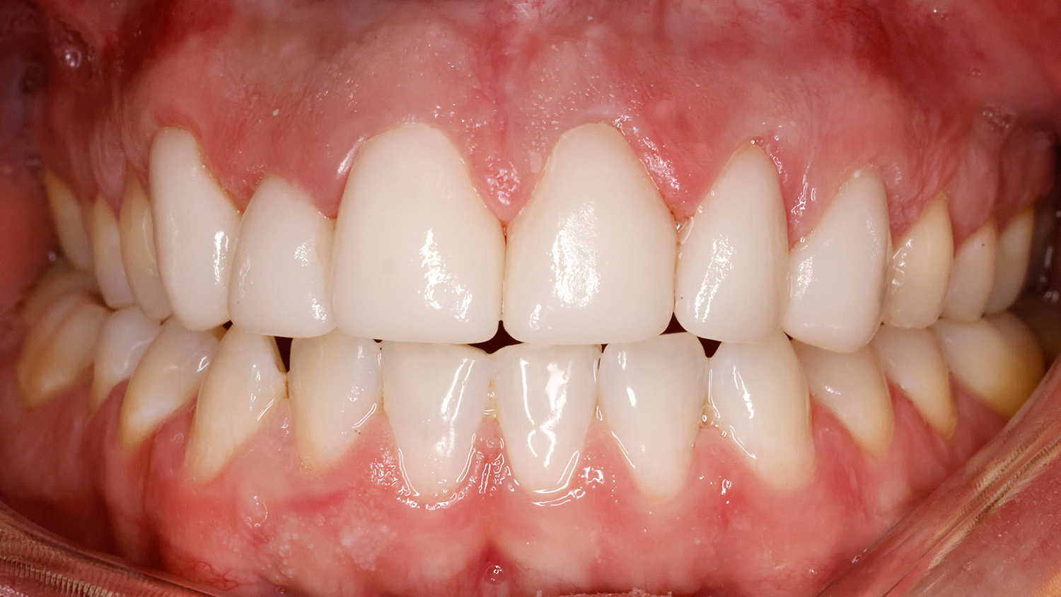 Close-up of a person's clean, well-aligned upper and lower teeth with healthy pink gums.
