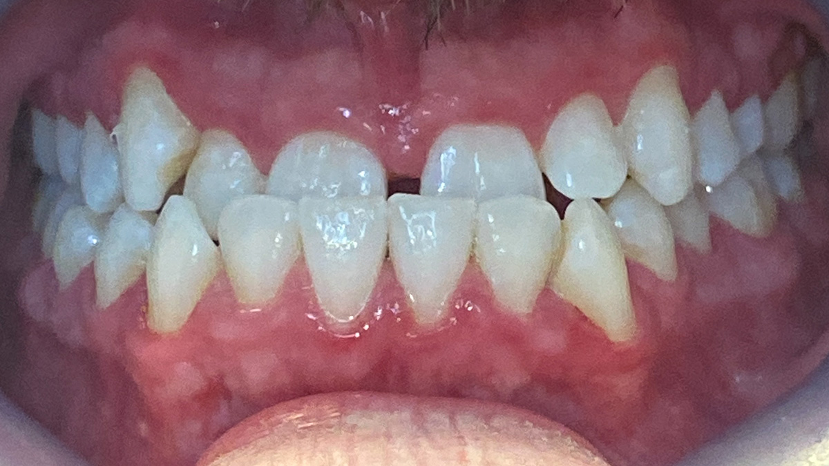 Close-up of a person's upper and lower teeth showing slight crowding and gaps between some teeth.