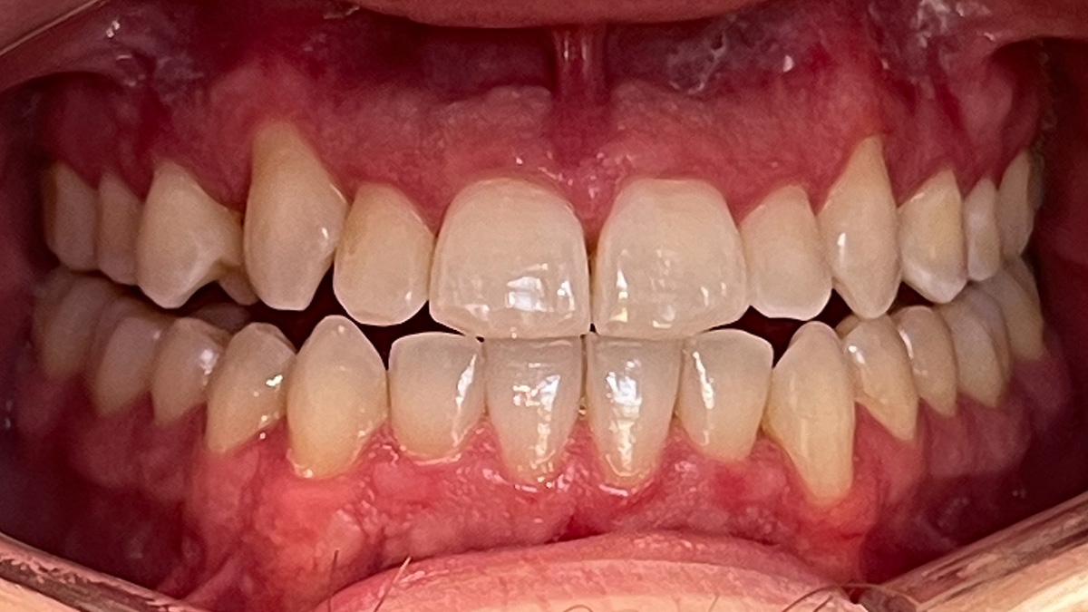 Close-up of upper and lower teeth showing misalignment and crowding with visible gums.