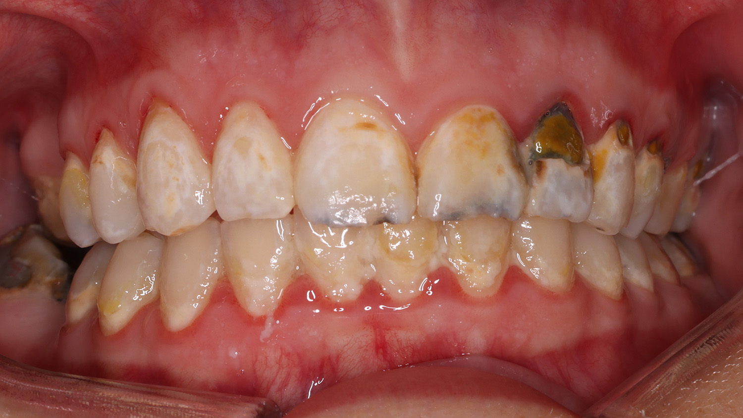 Close-up of upper and lower front teeth showing severe tooth decay, discoloration, and plaque buildup.
