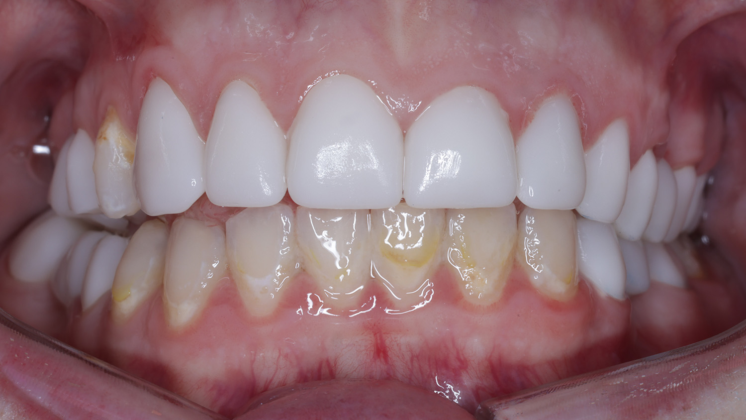 Close-up of upper and lower teeth showing dental crowns on upper front teeth and yellowish plaque on lower teeth.