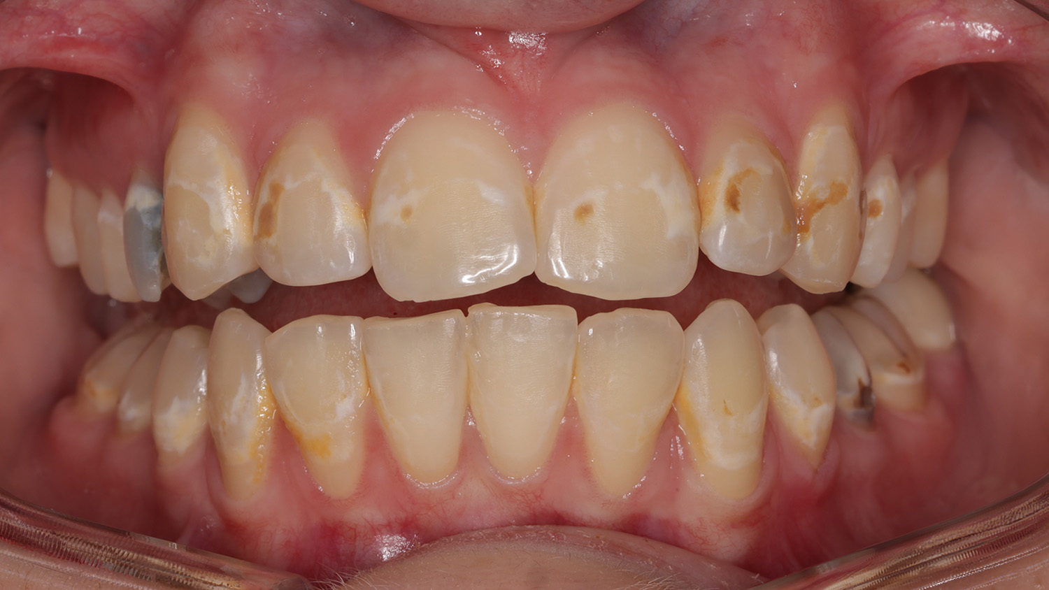 Close-up of human teeth with visible white spots and brown discoloration indicating enamel demineralization or staining.