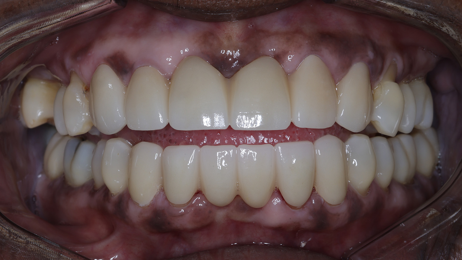 Close-up of a mouth with upper and lower teeth showing dental restorations and healthy gums.