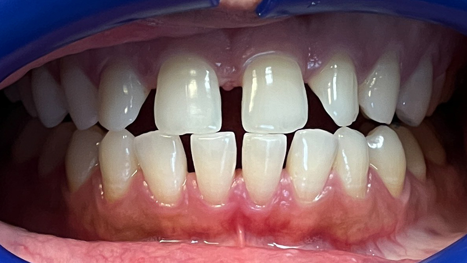 Close-up of open mouth showing upper and lower front teeth with noticeable gaps between them.