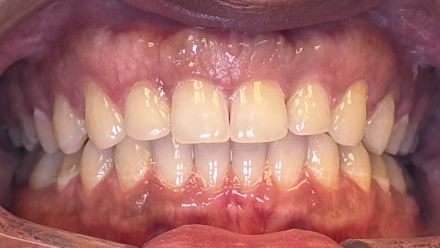 Close-up of a person's upper and lower teeth with slightly stained, unevenly aligned teeth and visible gums.