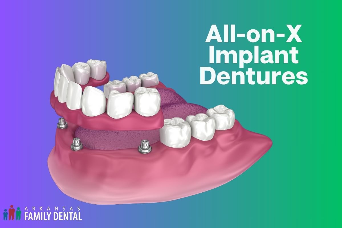 All-on-X Implants vs Traditional Dentures: What's Right for You? cover