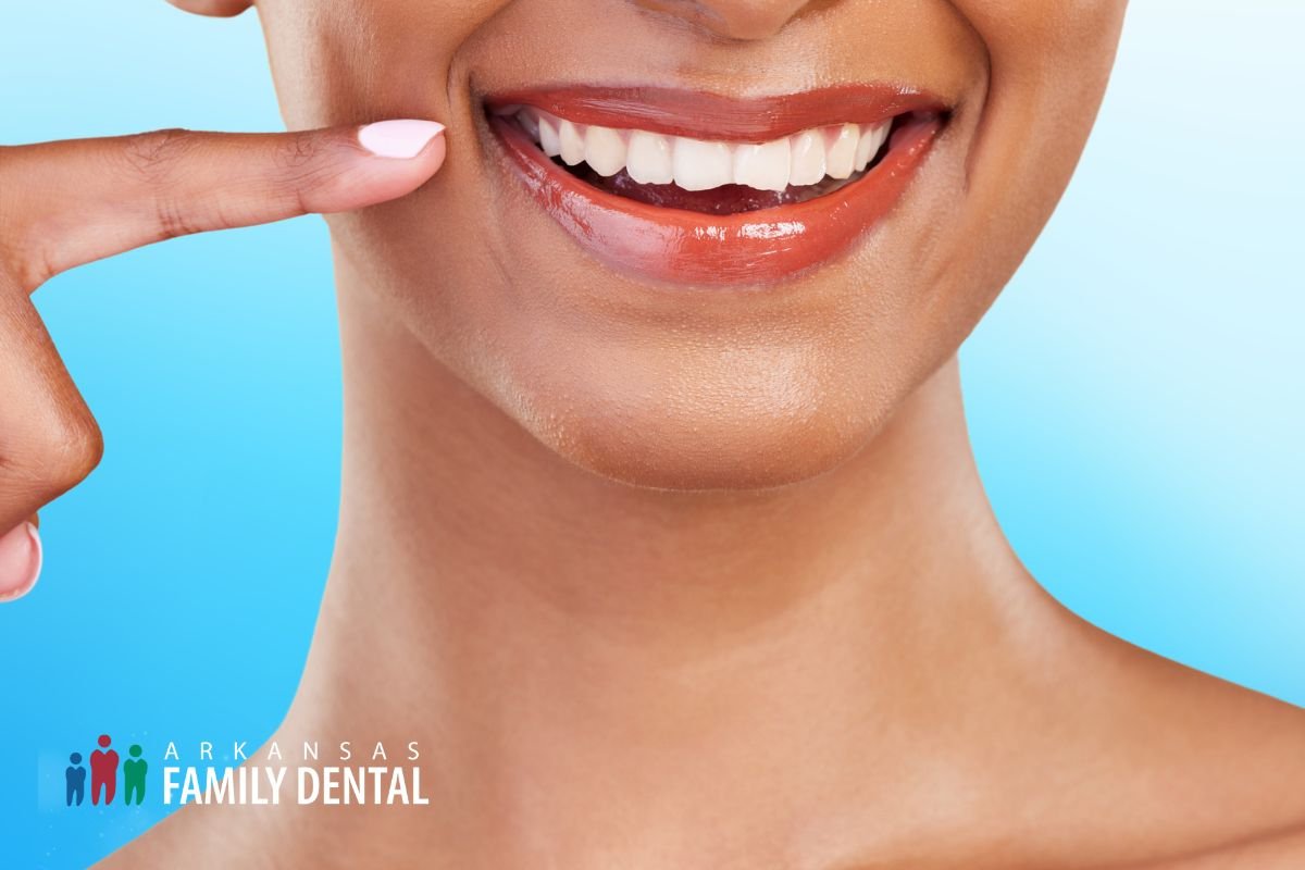 Benefits of Laser Teeth Whitening cover