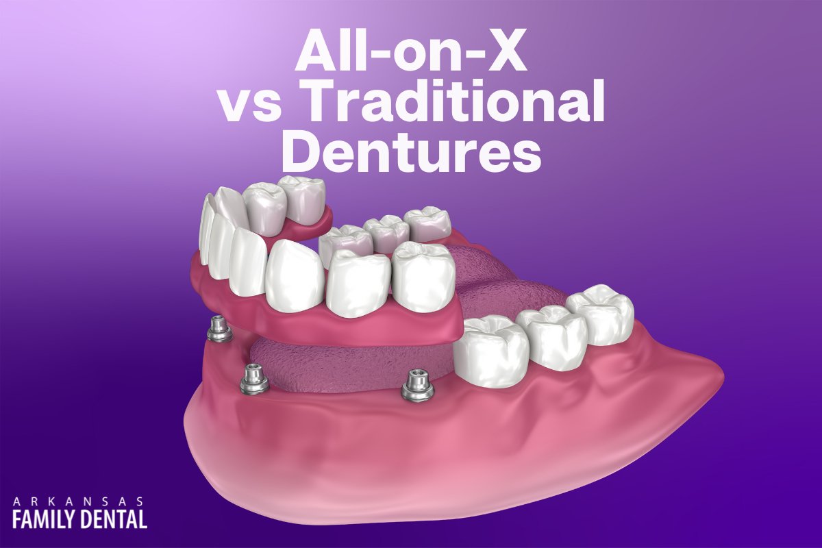 All-on-X vs Traditional Dentures: Which One is Right for You? cover