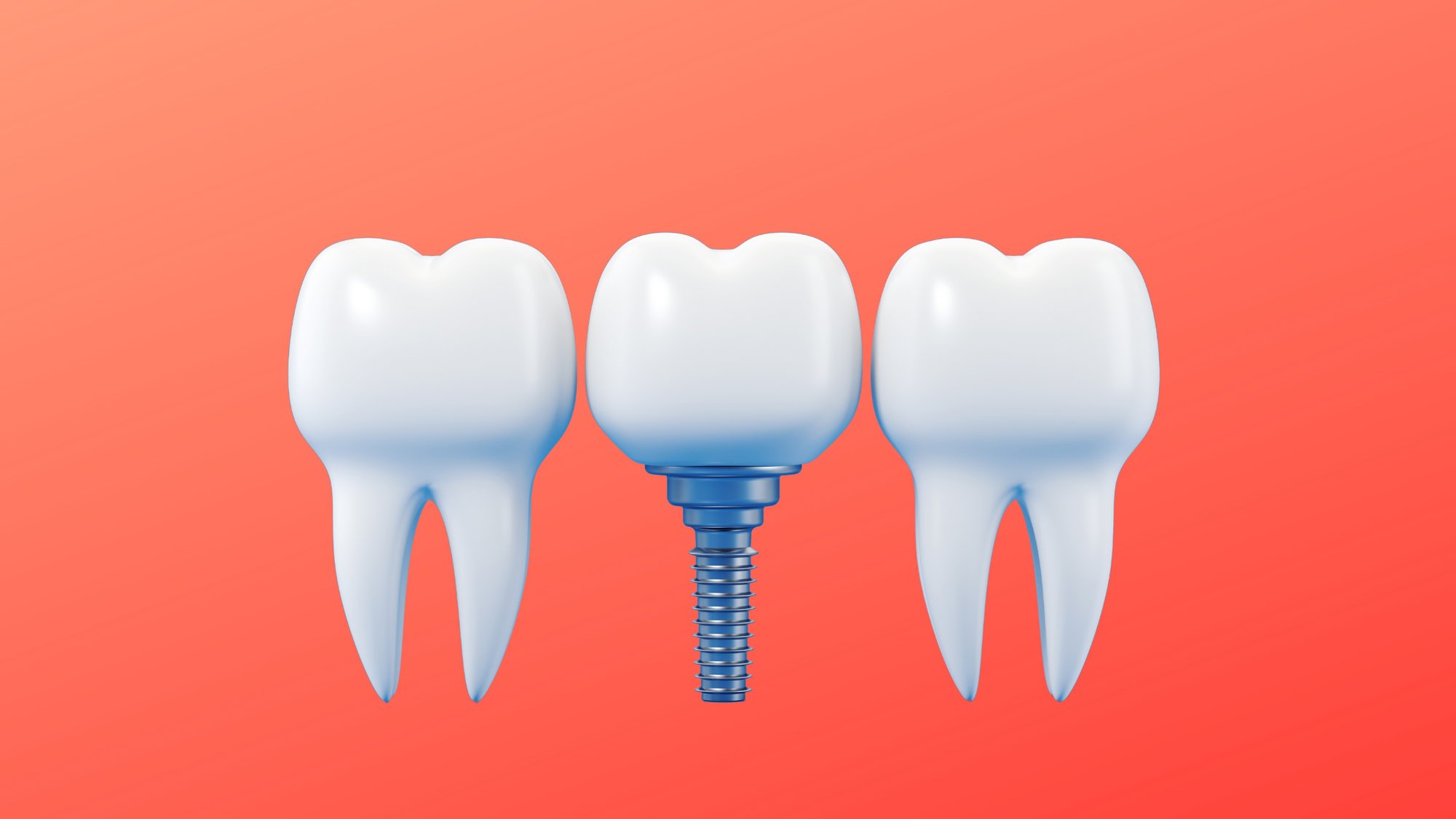 The All-on-X Implant Lifespan Meets Expectations cover