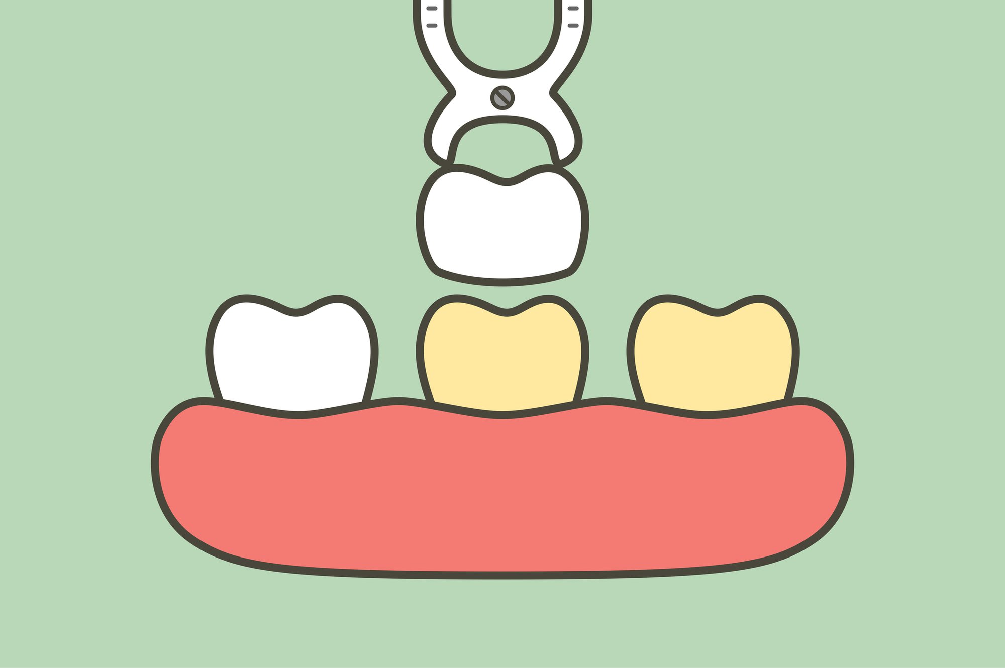 Veneers or Invisalign? These cartoon teeth are getting a veneer bonded to one tooth.