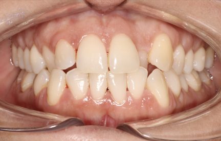 A close up of Patient Number Three's teeth show they are crooked, unevenly spaced, and set forward or back in the gumline.