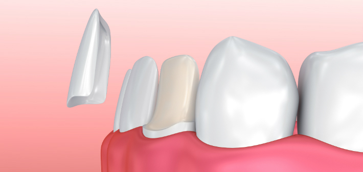 dental veneers before and after