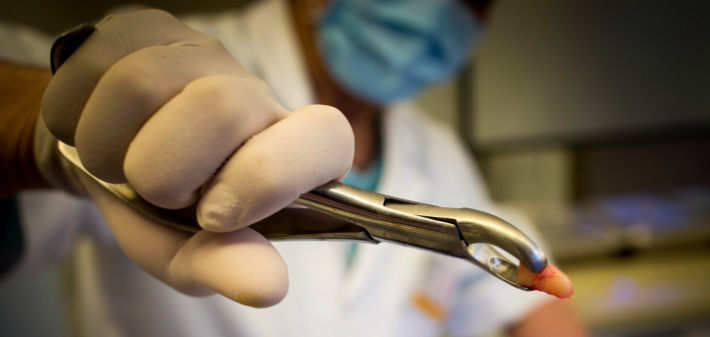 Little Rock tooth extraction