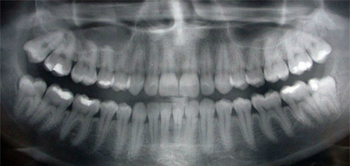 digital dental x-ray