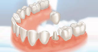 Porcelain Crowns Arkansas Family Dentistry