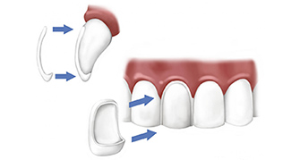 Porcelain Veneers Arkansas Family Dentistry1