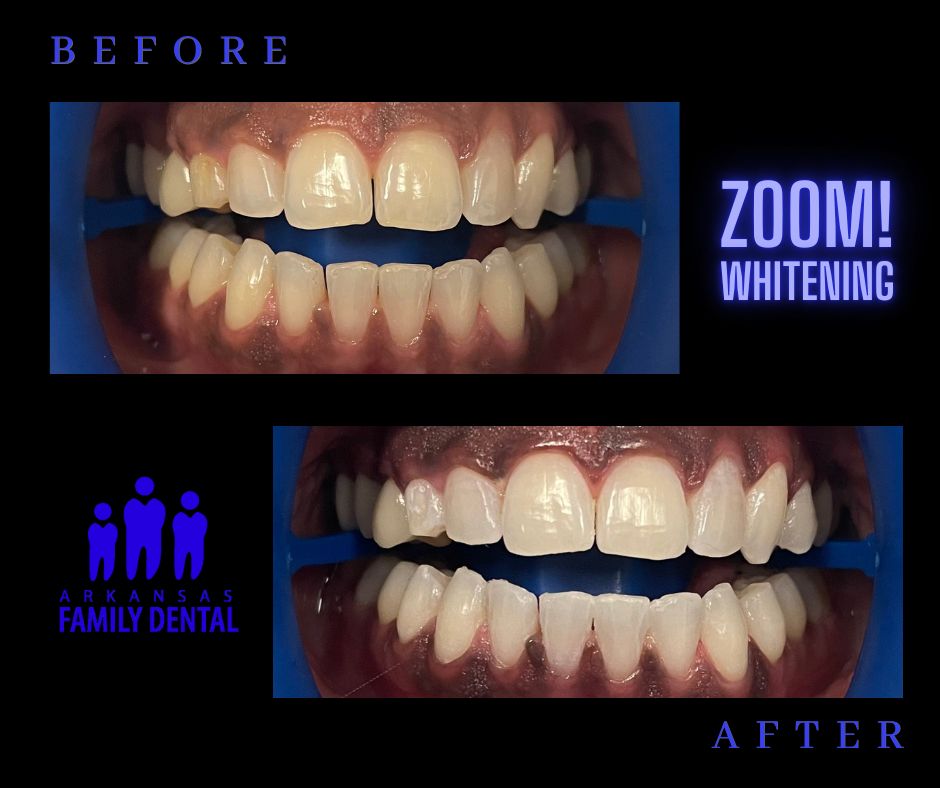 ZOOM before and after