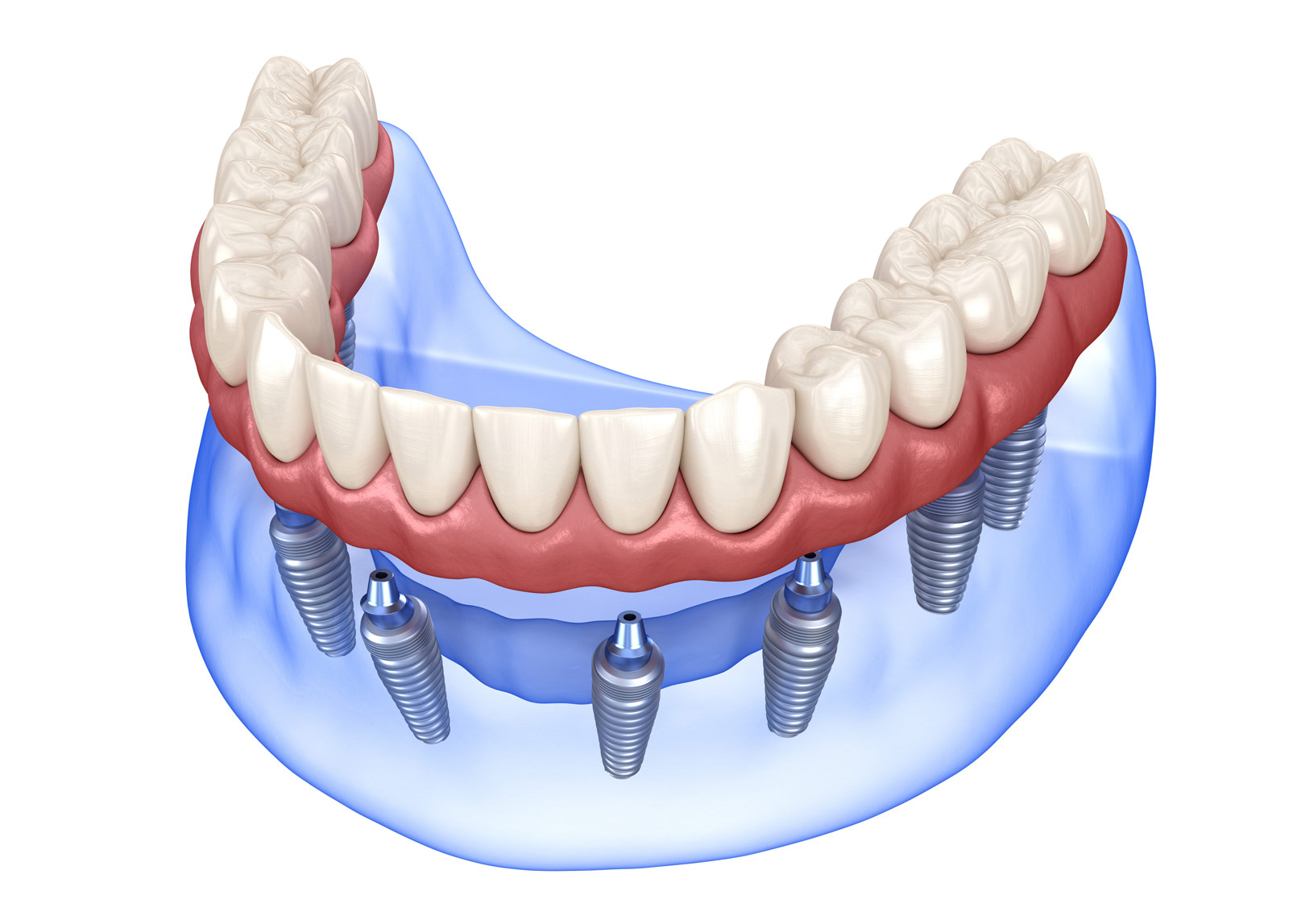implant dentures