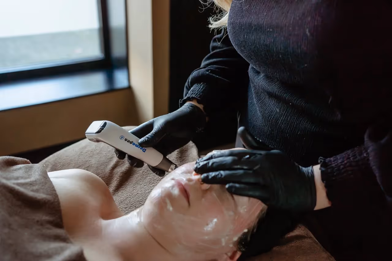 microneedling rietmolen