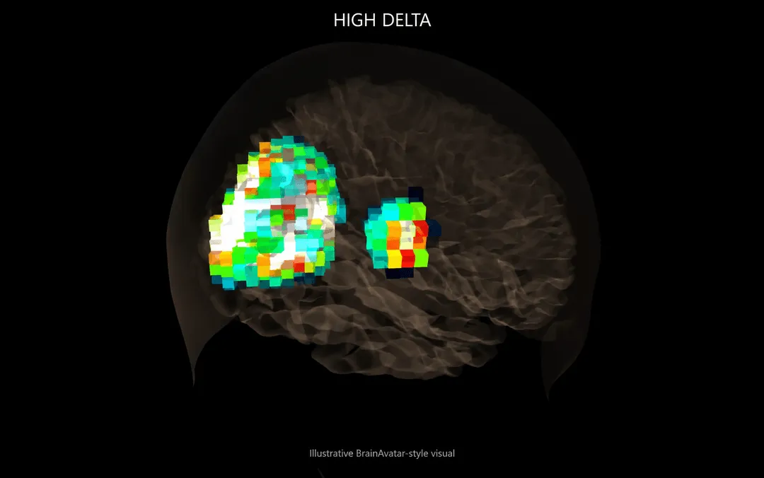 Brain map showing high delta activity across the front and centre of the brain