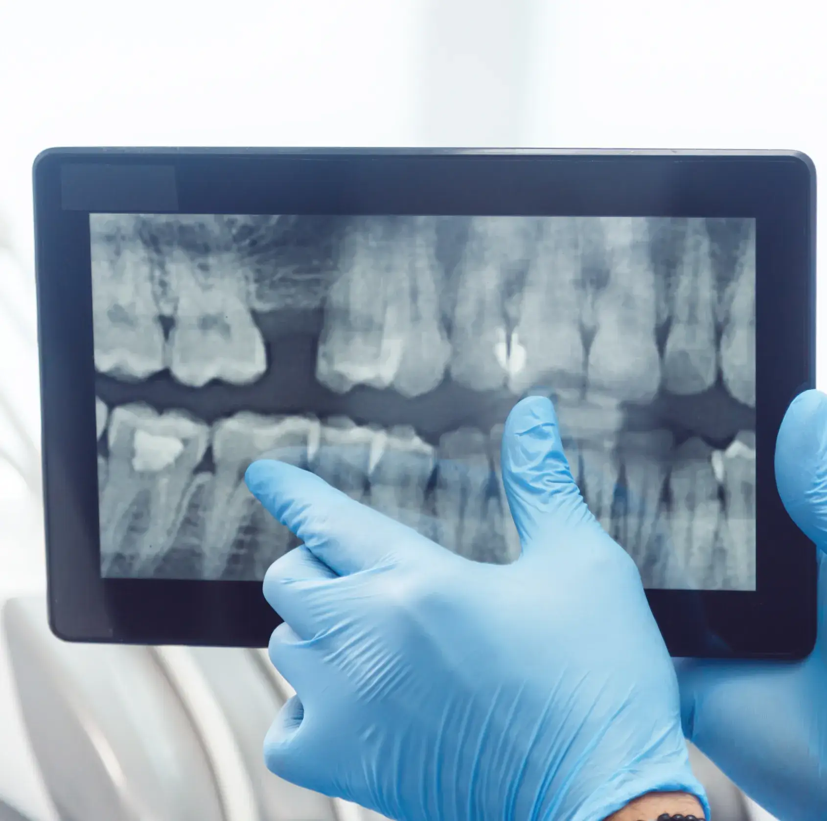 Dental professional wearing blue gloves pointing at a tooth on a digital dental X-ray displayed on a tablet.