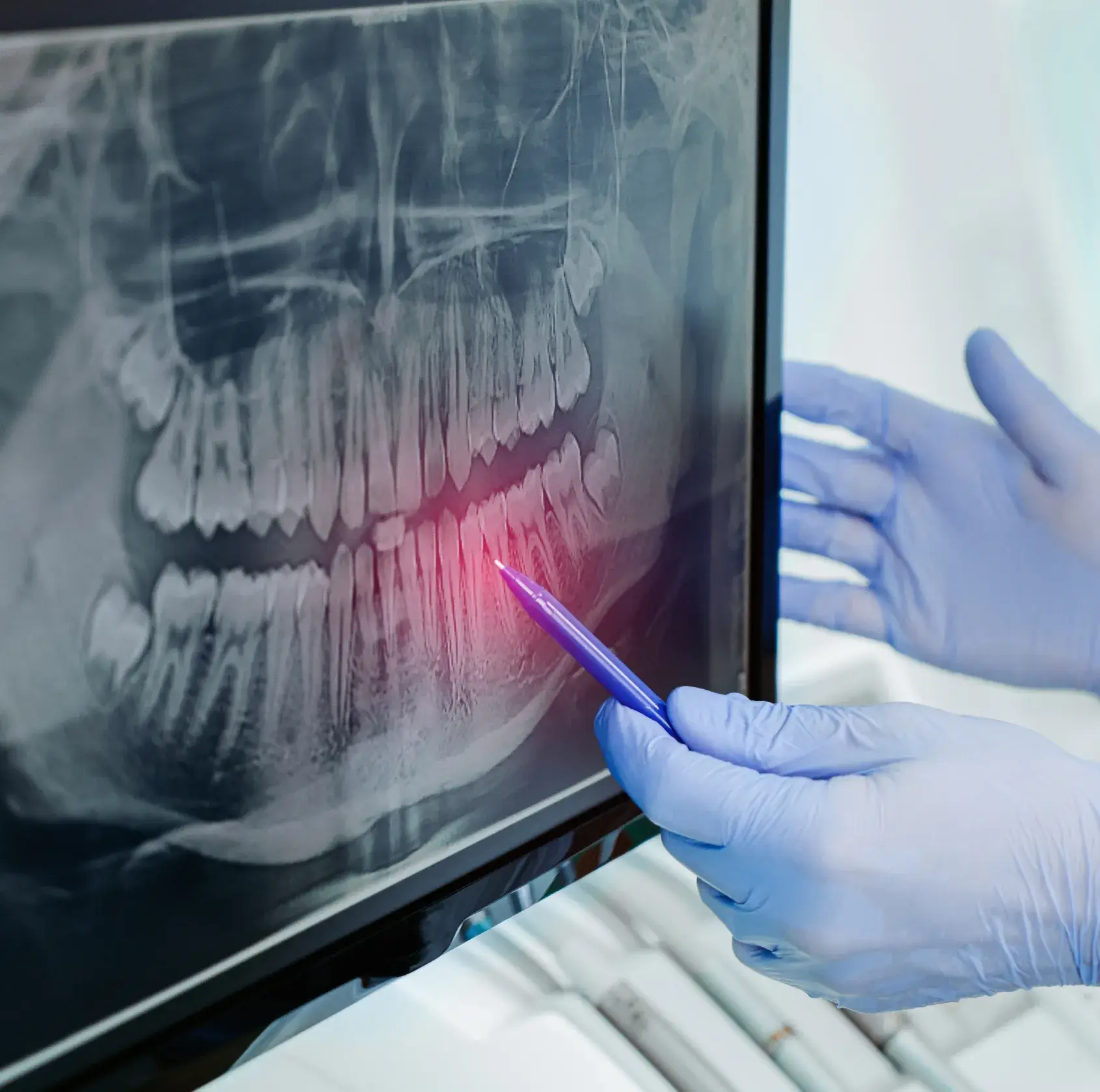 Gloved hands pointing with a pen at a highlighted area on a dental X-ray showing teeth and jaw.