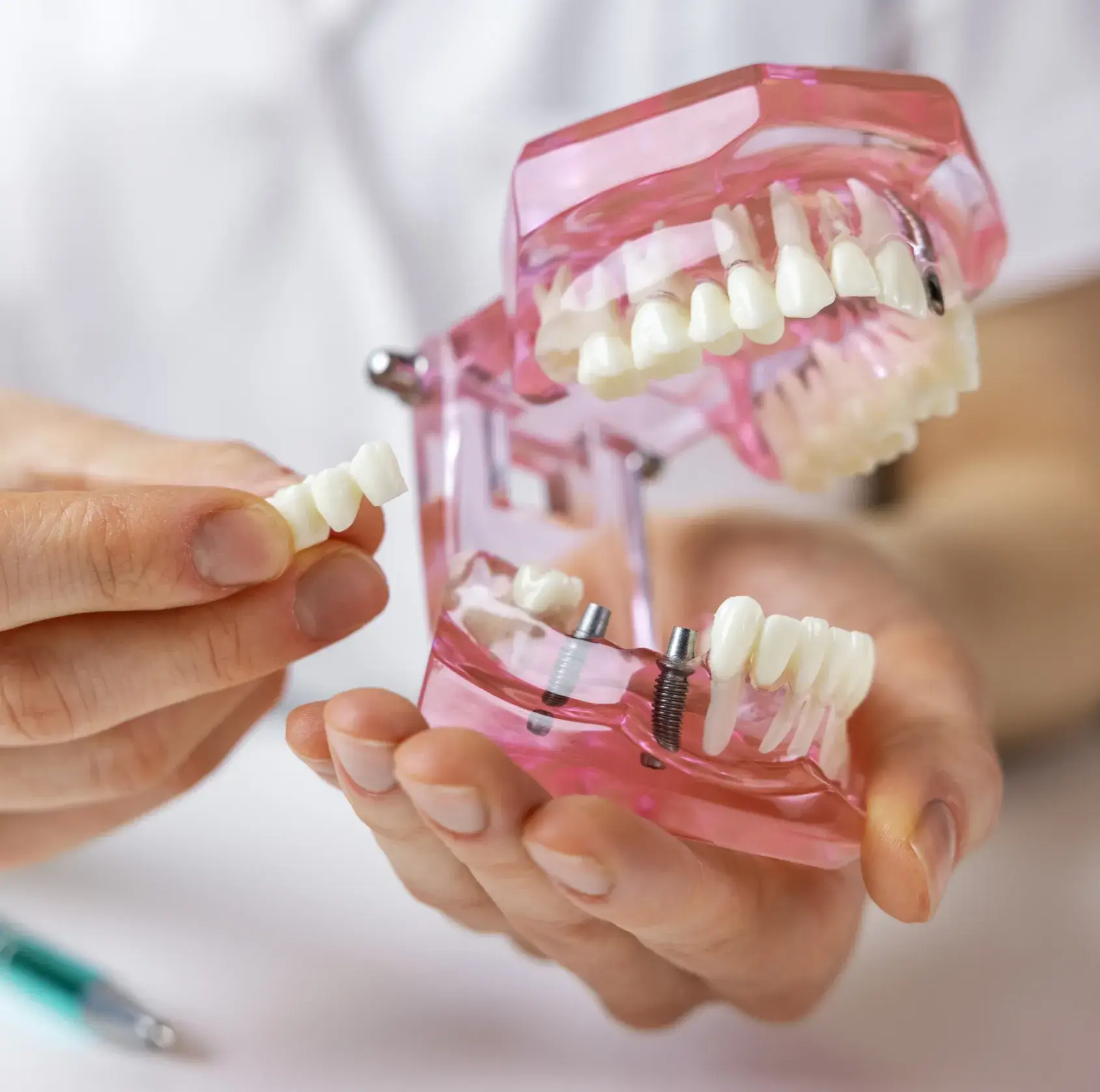 Hands holding a dental model showing teeth implants and a detachable dental bridge.