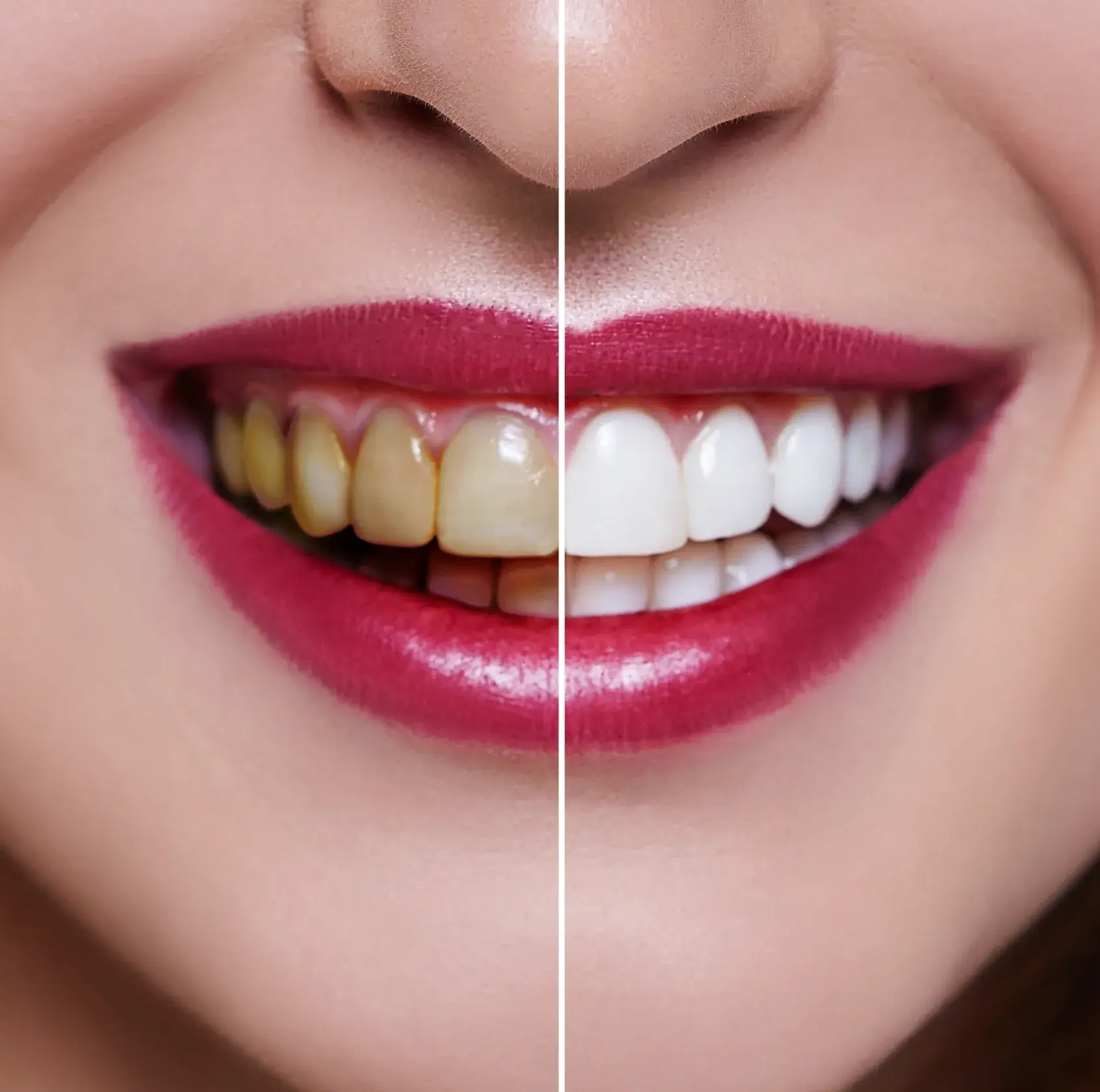 Close-up of a smiling mouth showing a teeth whitening comparison with yellow stained teeth on the left and bright white teeth on the right.