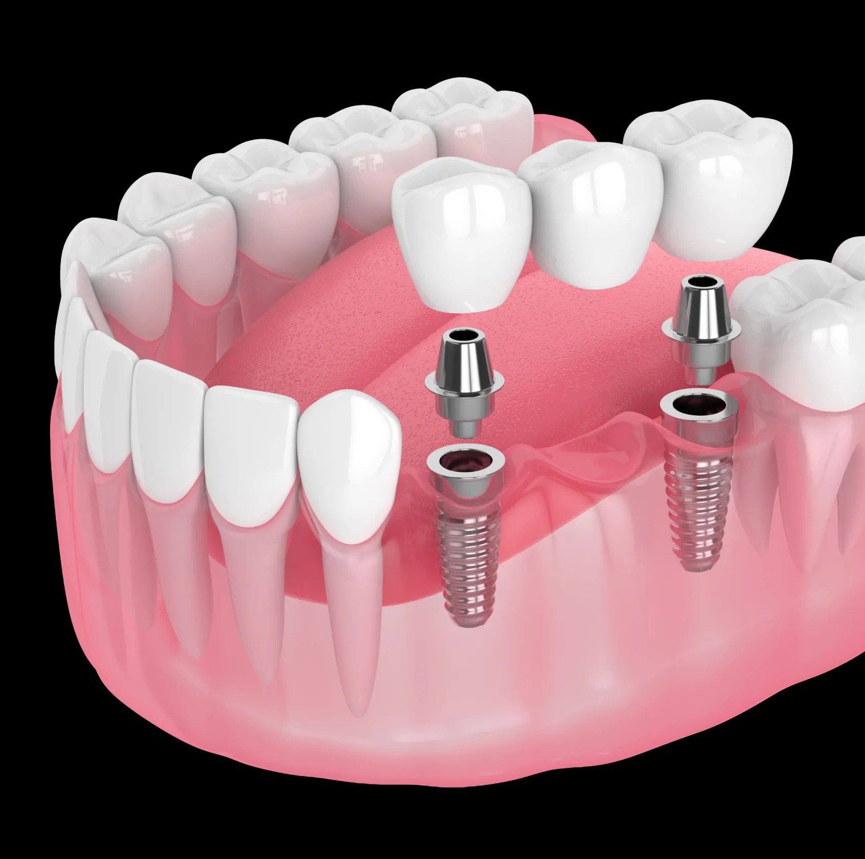 3D illustration of lower jaw with two dental implants supporting a dental bridge replacing missing molars.